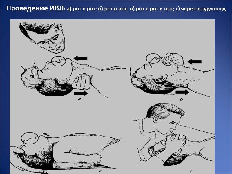 Проведение ИВЛ: а) рот в рот; б) рот в нос; в) рот в рот